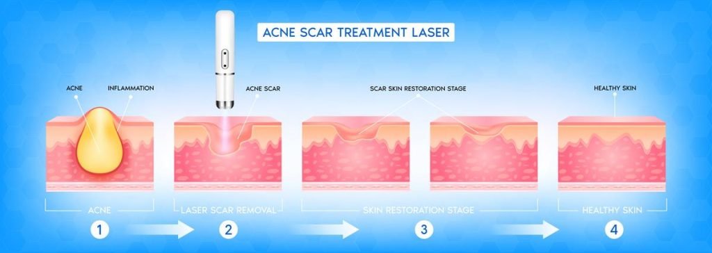 acne laser treatment