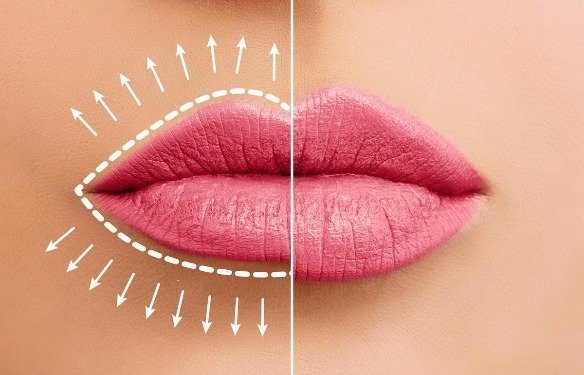 Natural Lip Fillers Before and After: Stunning Results