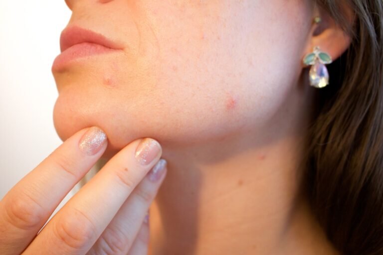 Acne Marks Vs Acne Scars: How To Difference And Deal With It